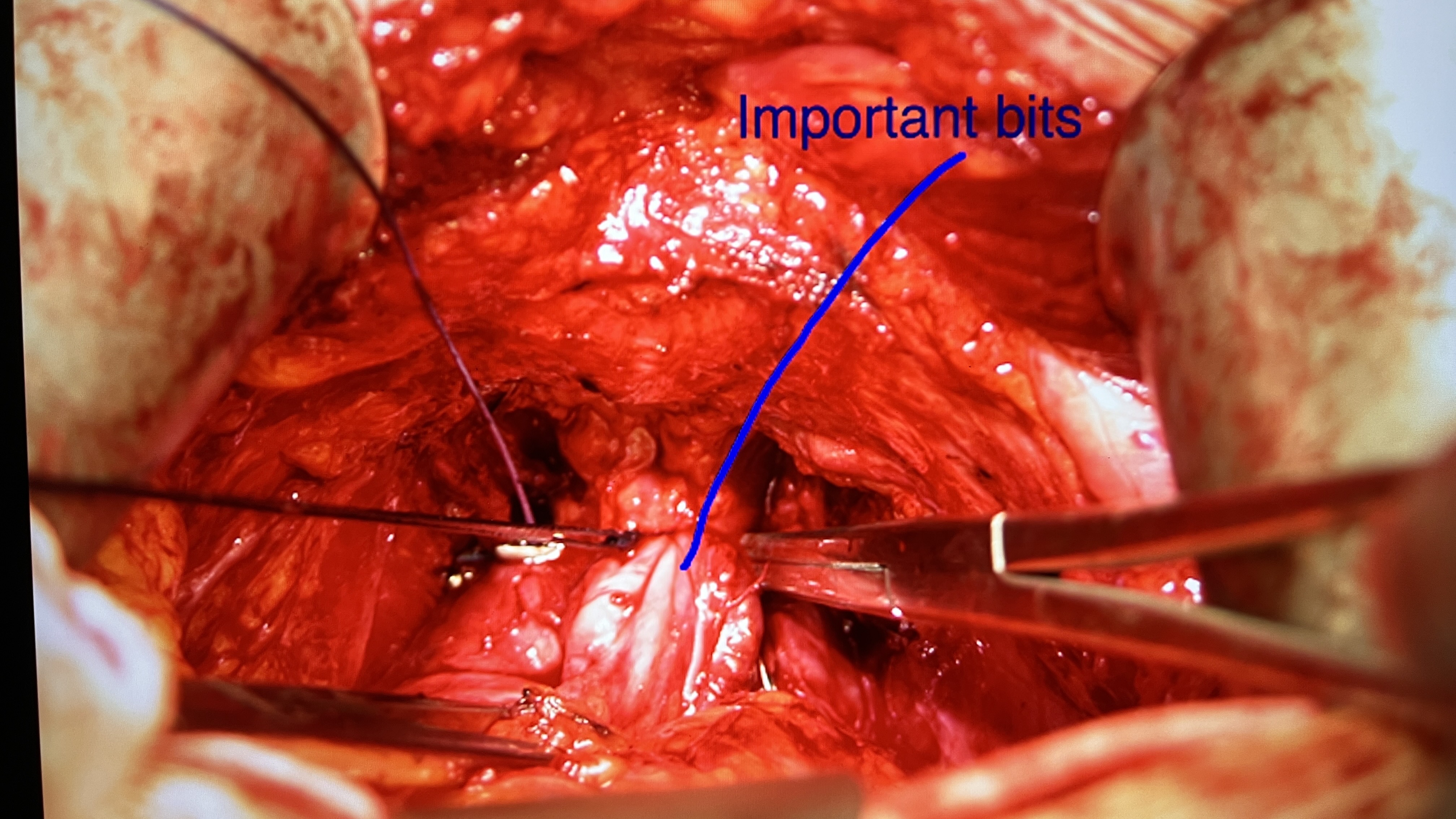Graphic operative photograph from prostate removal surgery with important structures marked