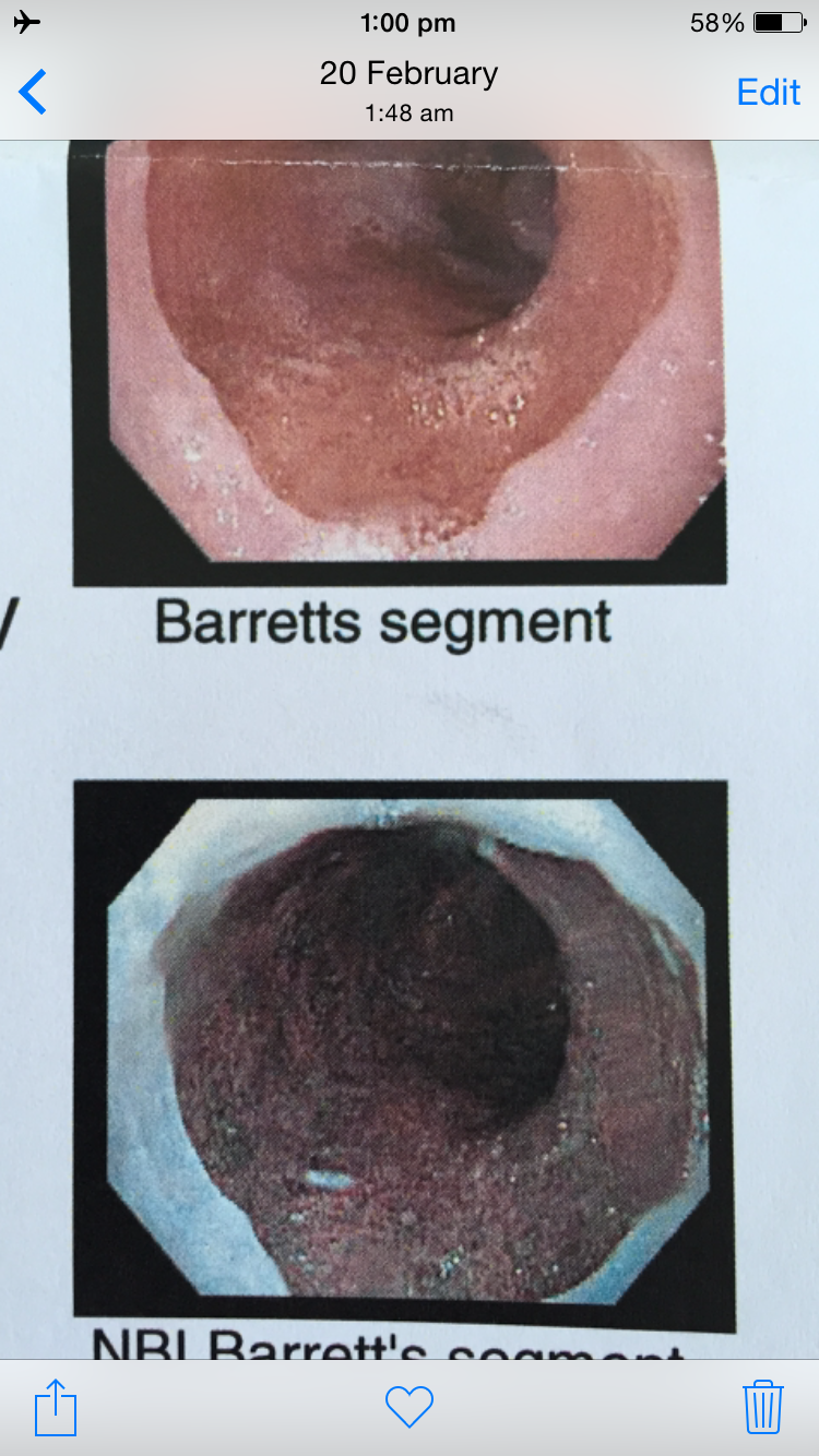 Endoscopy report example showing Barrett's segment images