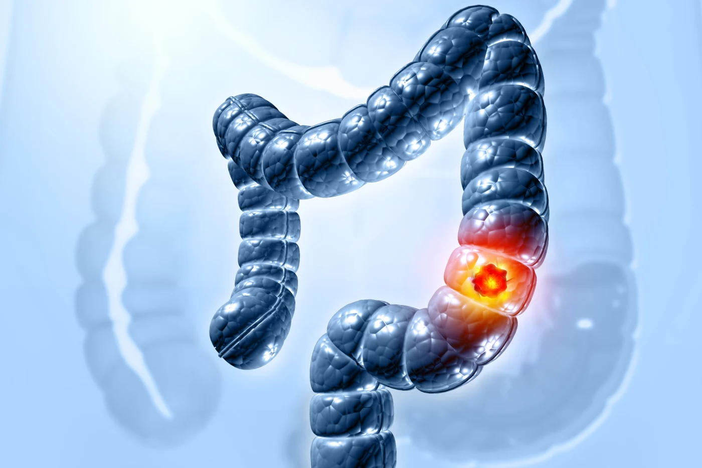 Medical illustration of a bowel cancer in the colon