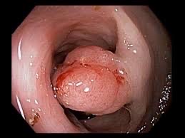Graphic colonoscopy example of an abnormal bowel lesion