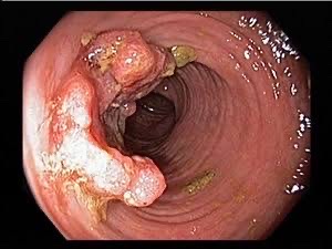 Colonoscopy example showing bowel polyps