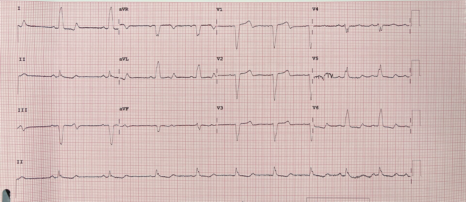 De-identified 12-lead ECG trace showing an abnormal conduction pattern