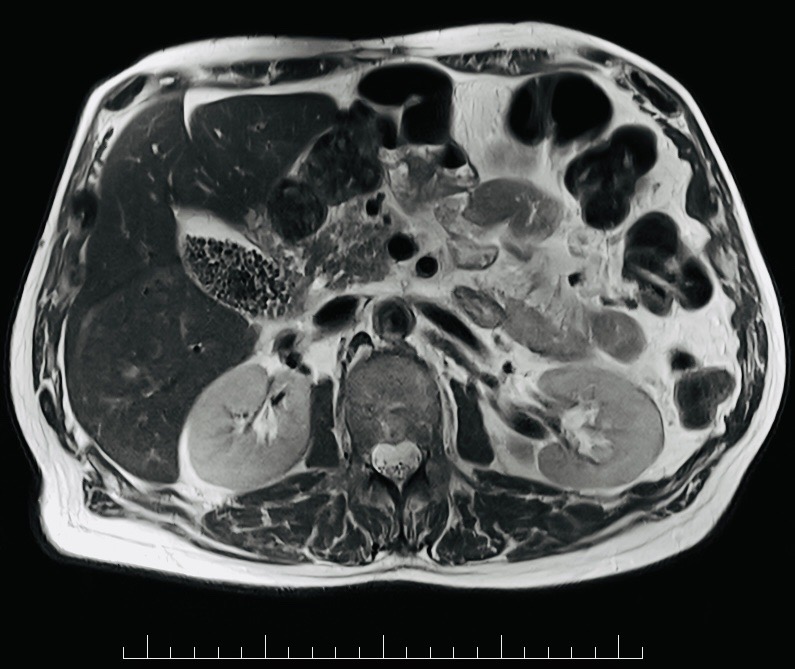 MRI abdomen example