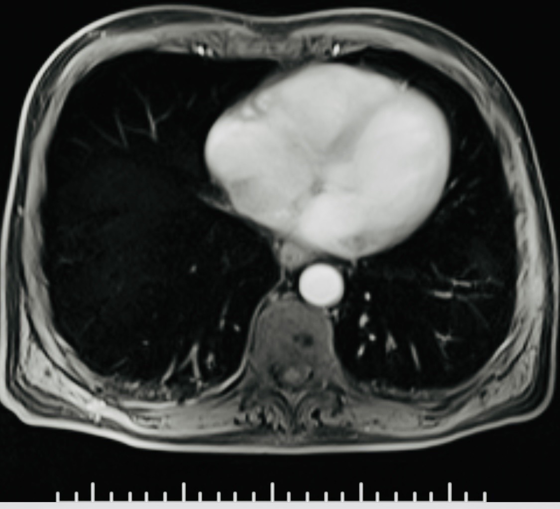 MRI chest and heart example