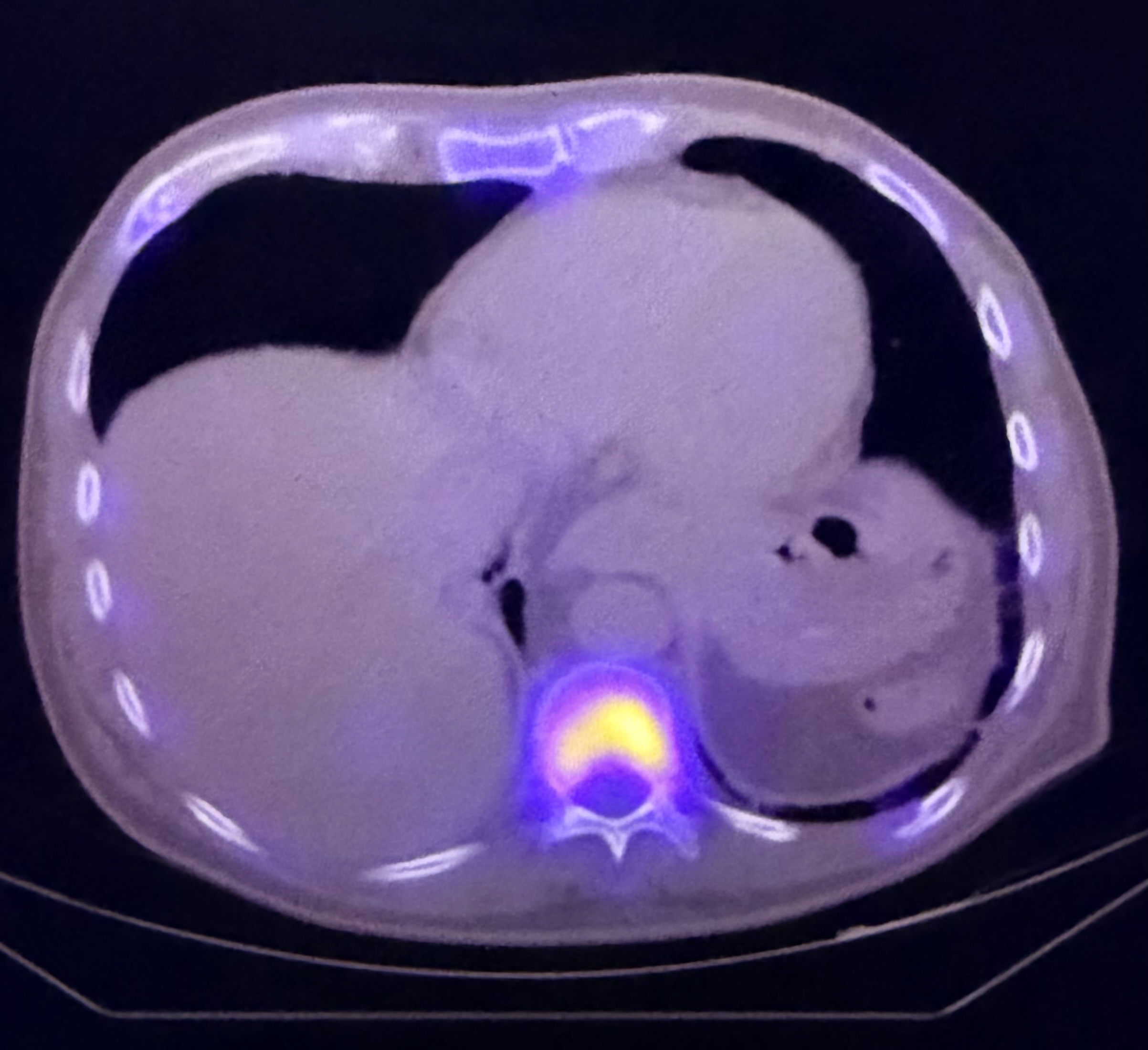 PET-CT scan example of the torso