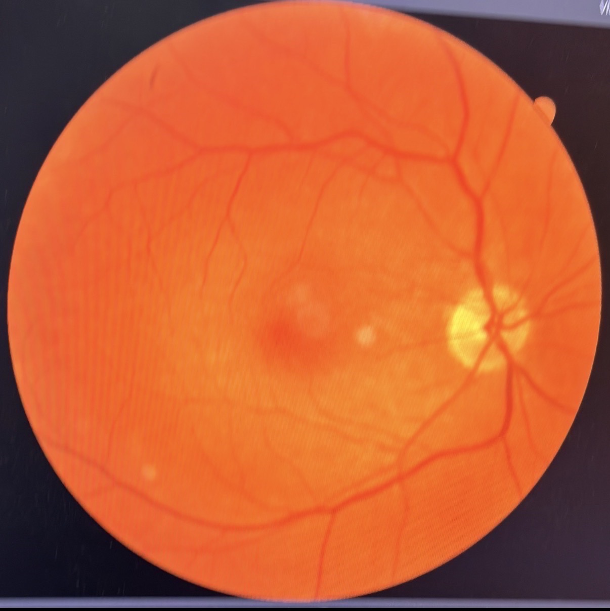 Retinal photograph showing optic nerve and blood vessels