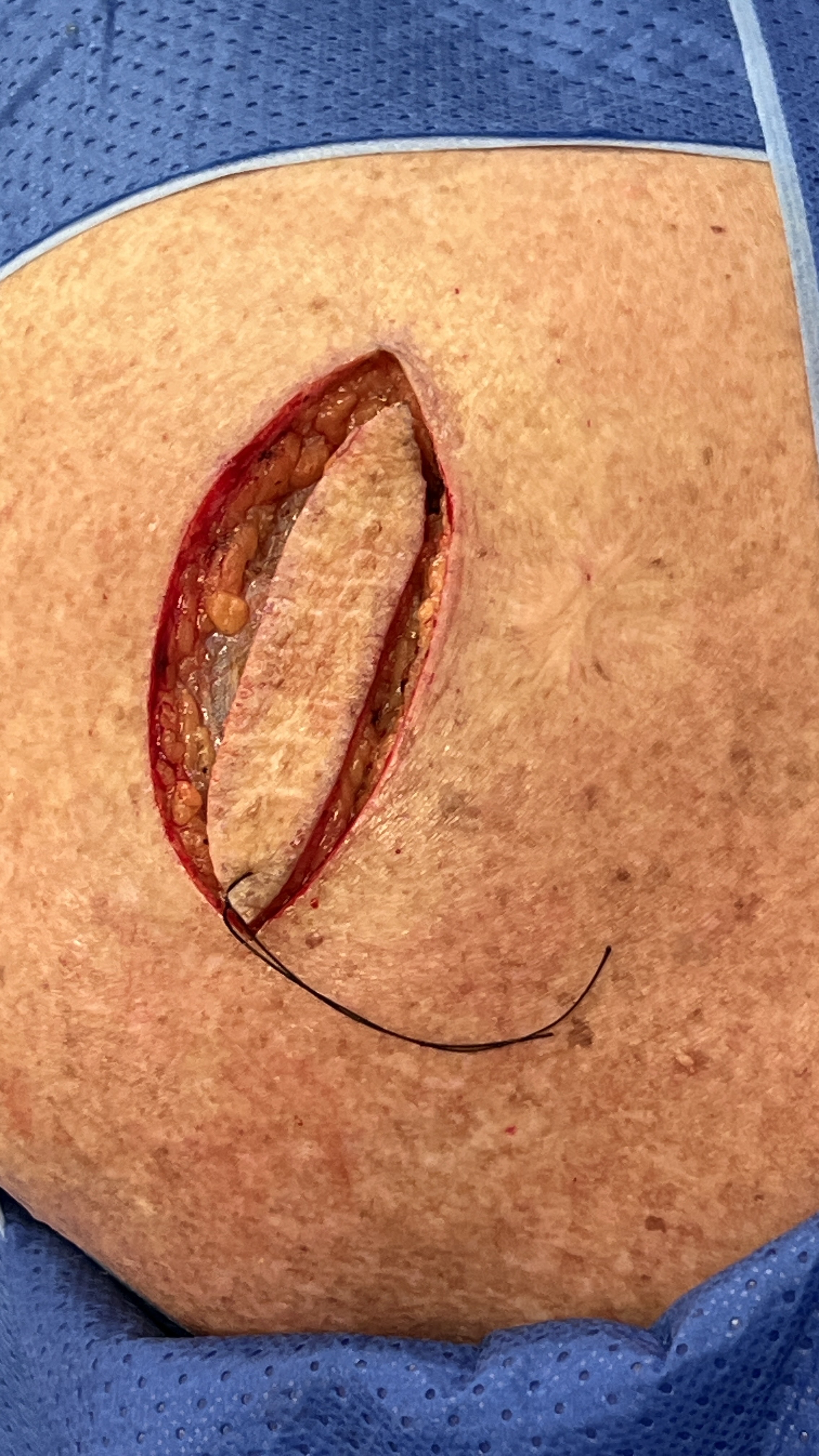 Graphic planned skin excision with suture before final closure