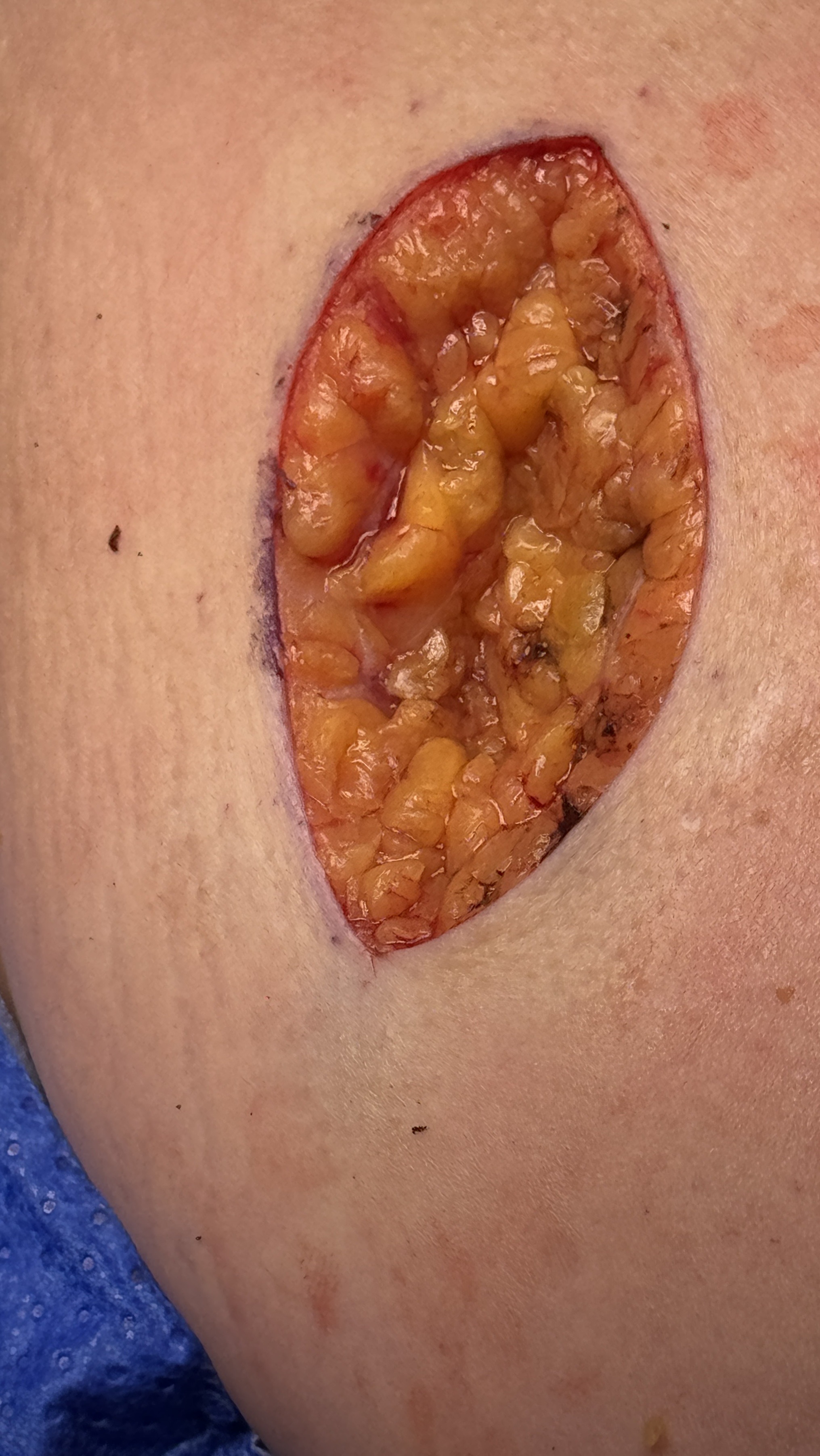 Graphic surgical wound after skin lesion excision before closure
