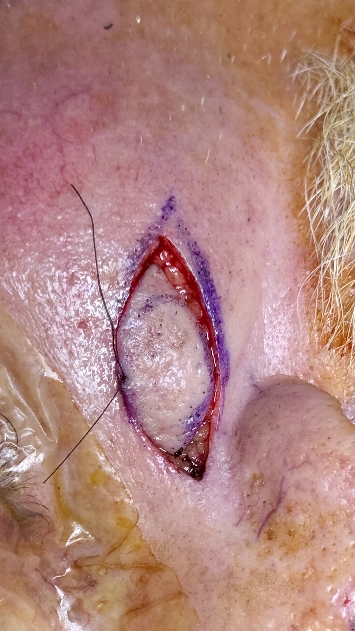 Graphic close-up facial skin cancer excision before closure