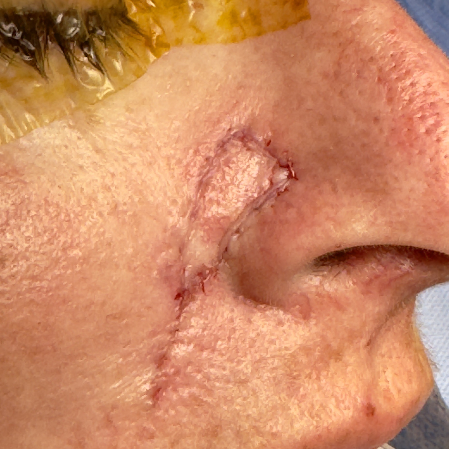 Nose skin cancer excision closed with sutures