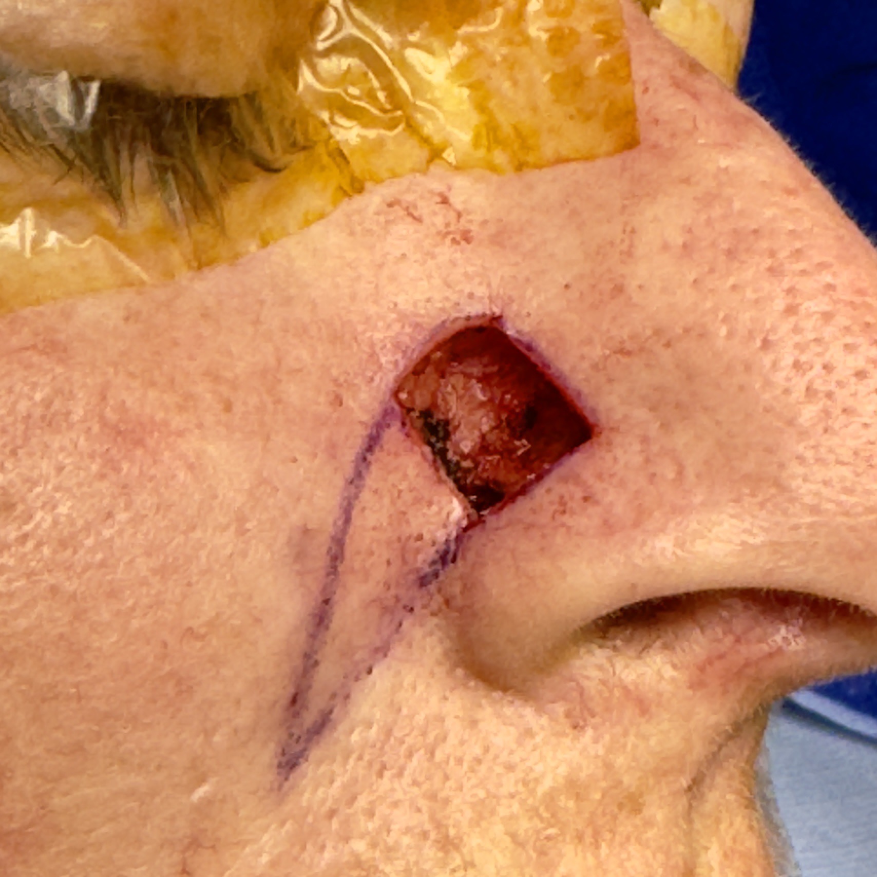 Graphic nose skin lesion excision before reconstruction