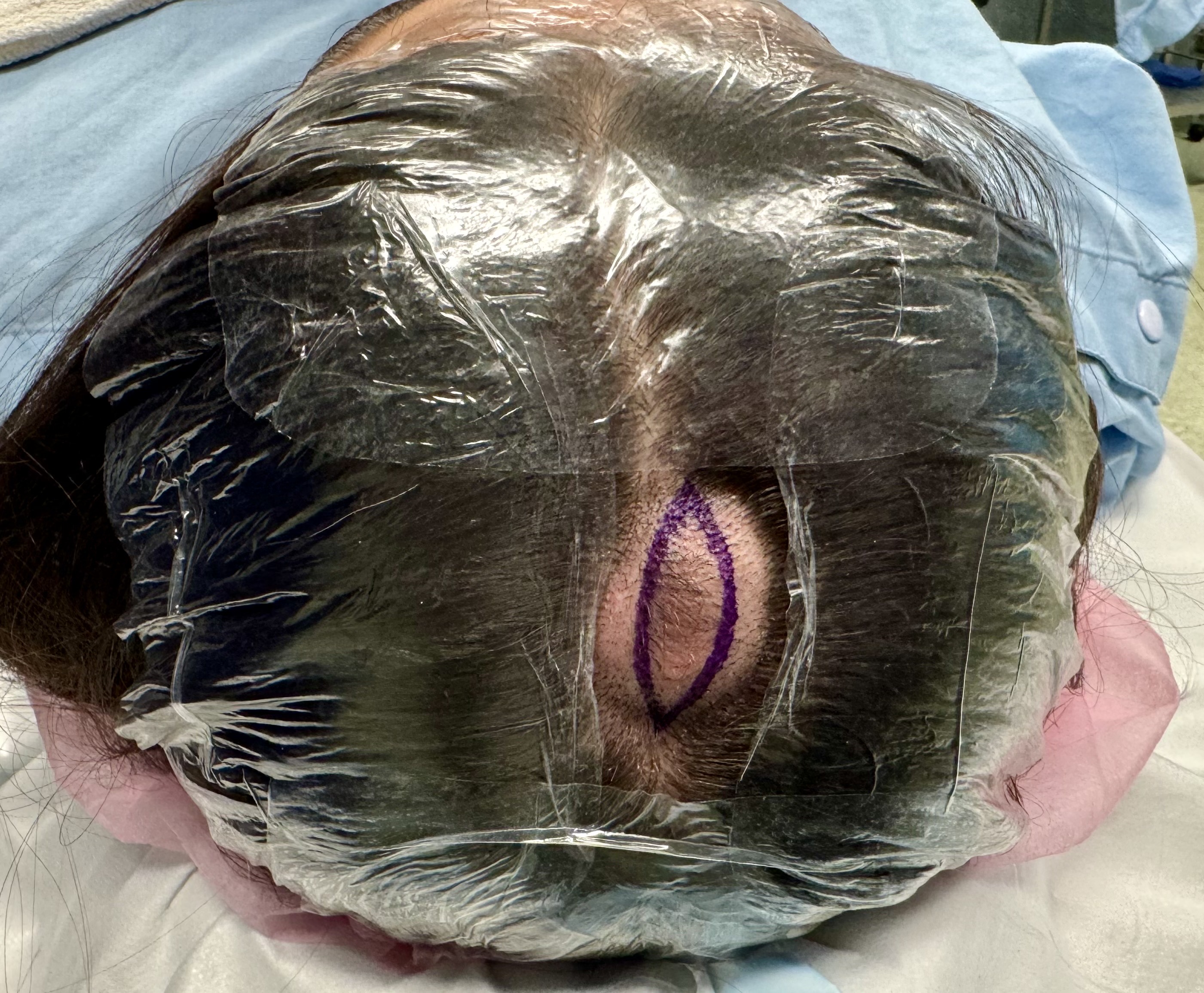 Scalp lesion marked before skin cancer excision